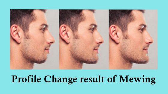 Mewing Myth: Can It Reshape Your Jawline?
