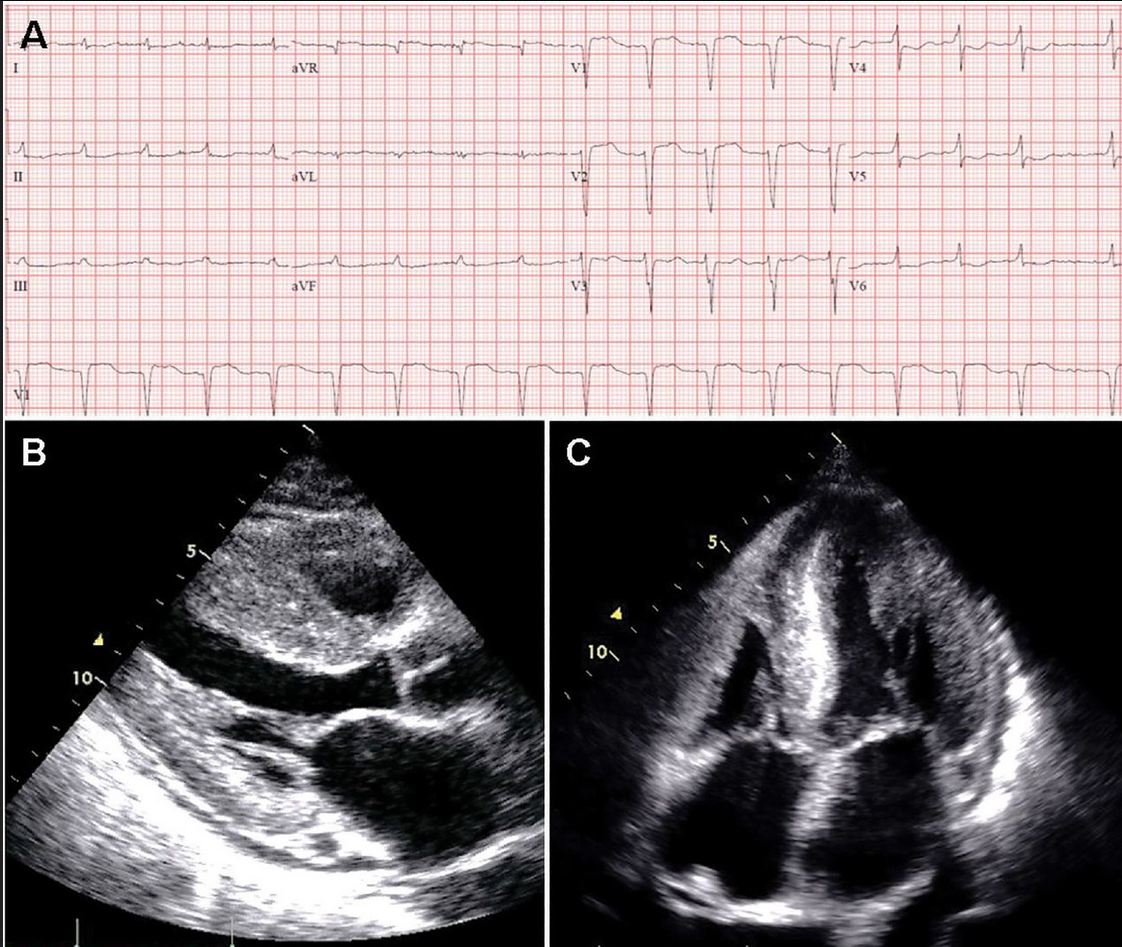 Amiloidosi cardiaca e lo studio EXCALIBUR: le aritmie sono silenti ma ci sono!