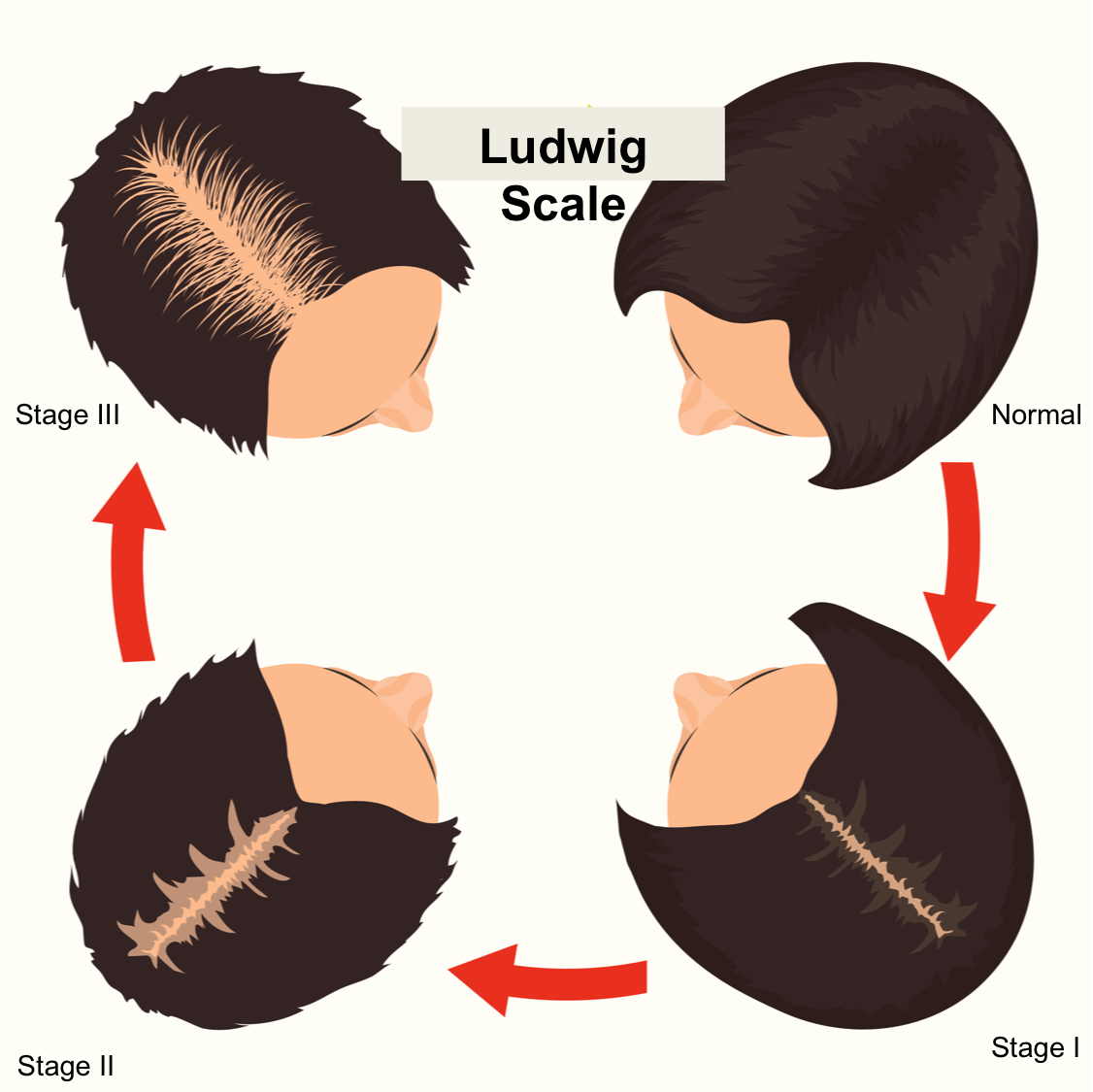 Understanding Female Pattern Baldness And The Ludwig Scale By Hairhealthai Medium 2482