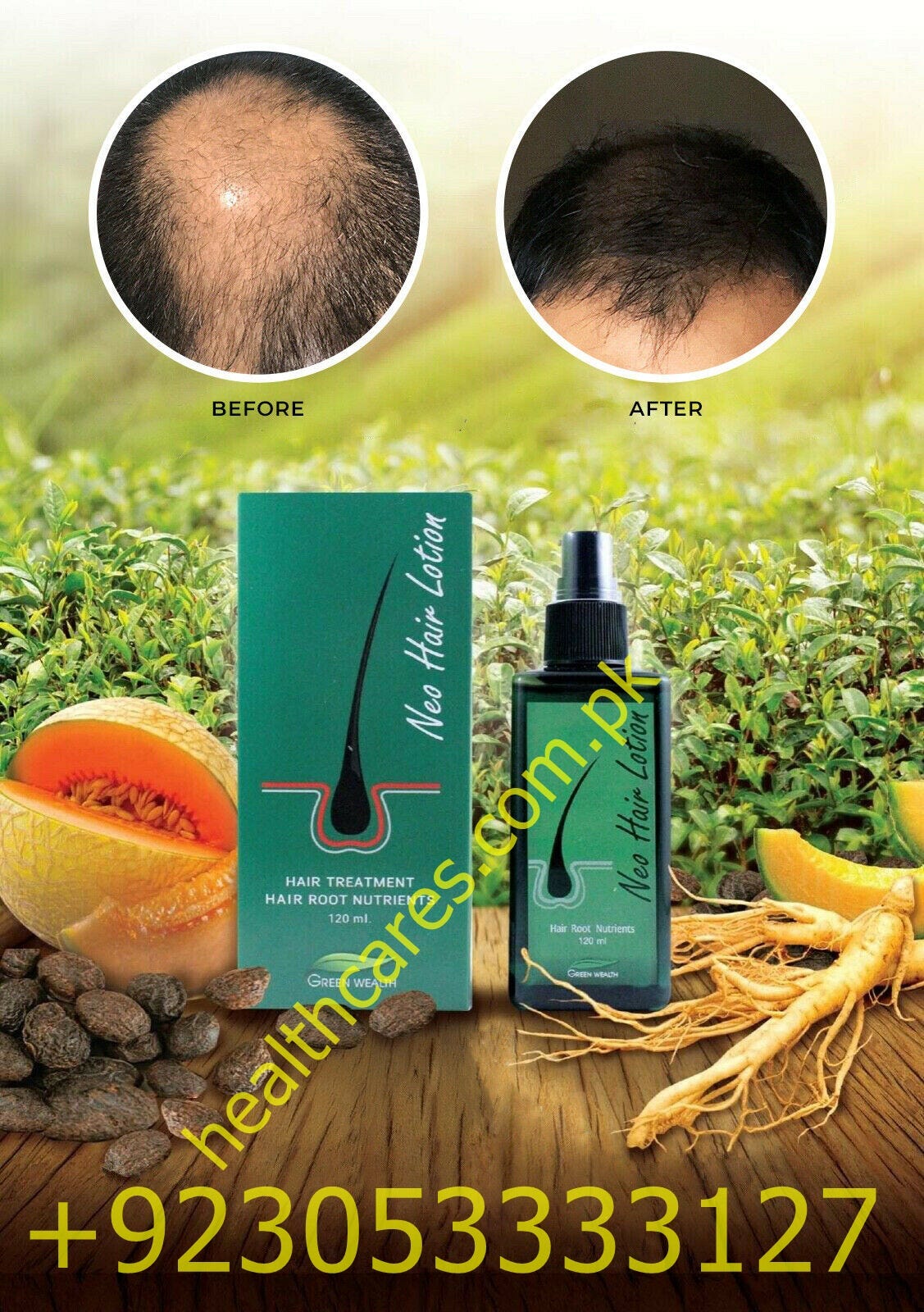 Neo Hair Lotion From Thailand. Visit The Official Website… by Health