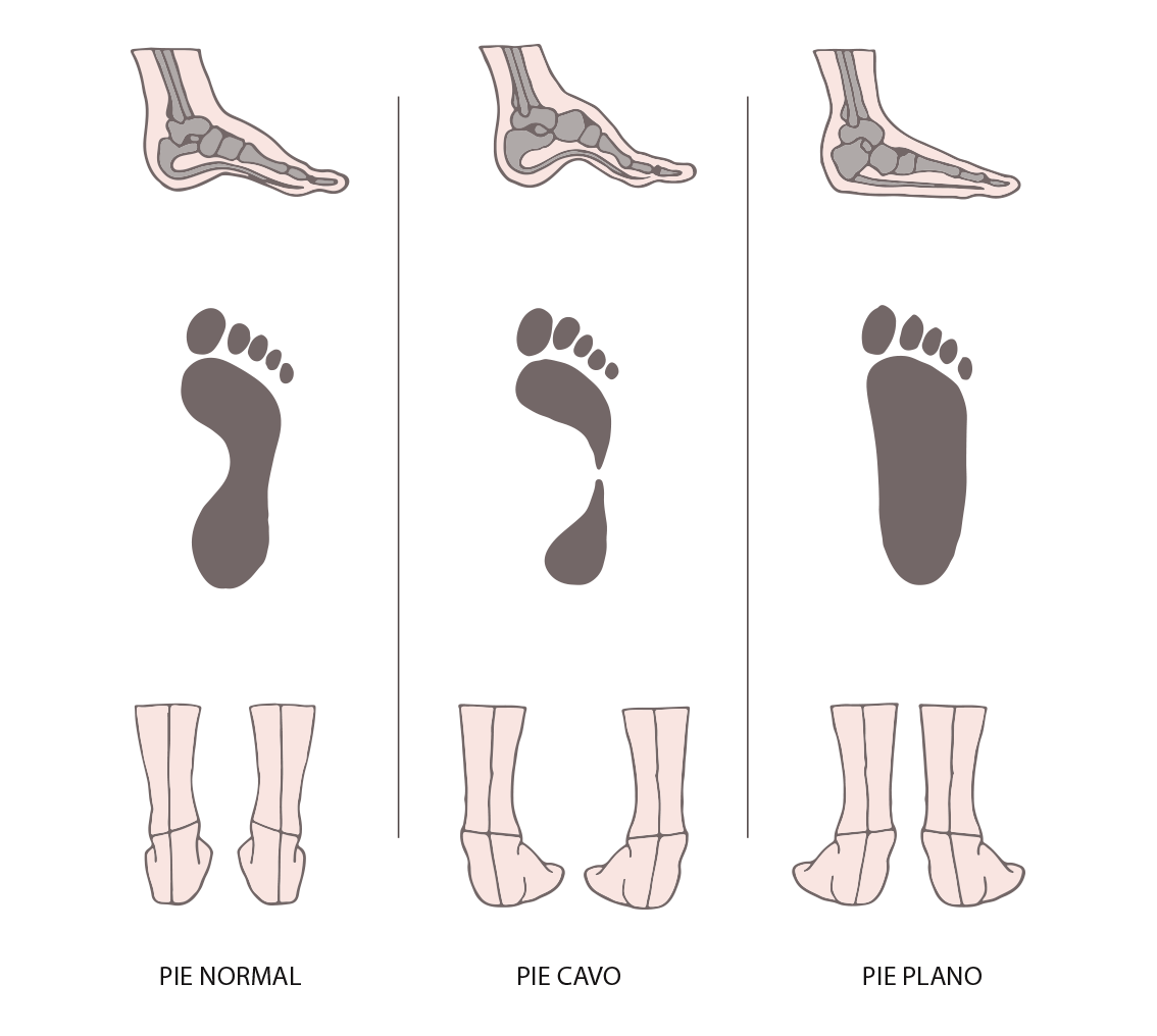 PIE CAVO Y PIE PLANO. La configuración morfológica de la… by Ebers