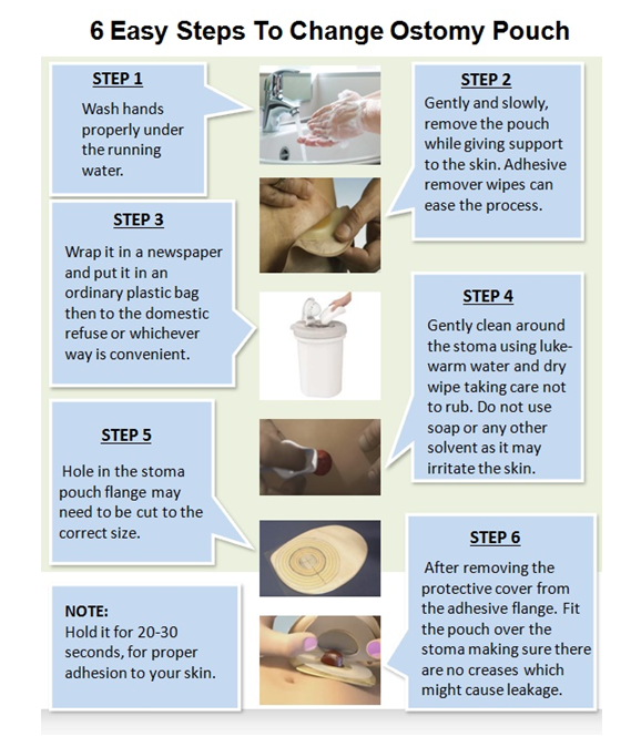 How Do You Clean a Colostomy Bag: Easy Steps for Effective Care