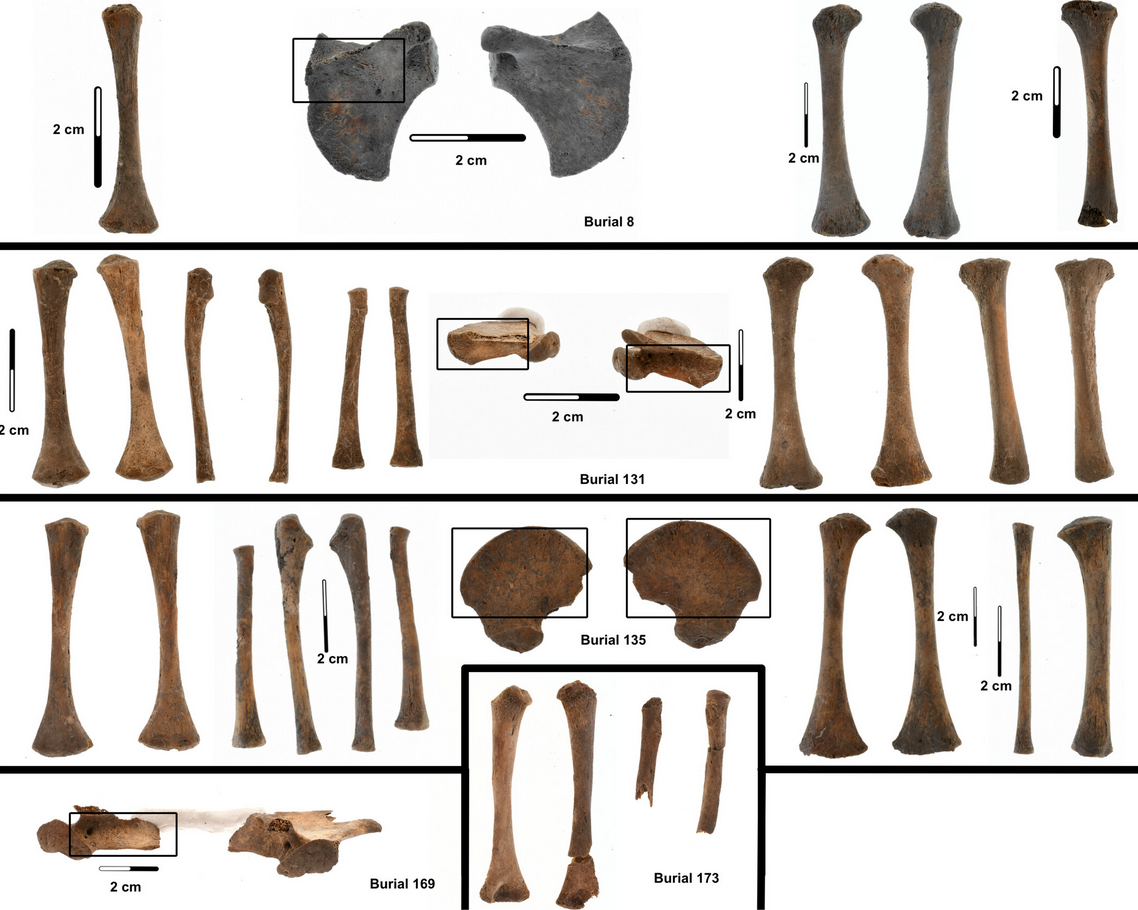 Post-cranial skeletal remains of five individuals from CA-ALA-11 (from top to bottom: ALA-B8, ALA-B131, ALA-B135, ALA-B169, and ALA-B173), showing macroscopic signs of scurvy including reactive bone deposits on the scapulae, long bones, and pelvis. Credit: Caine et al. 2026.