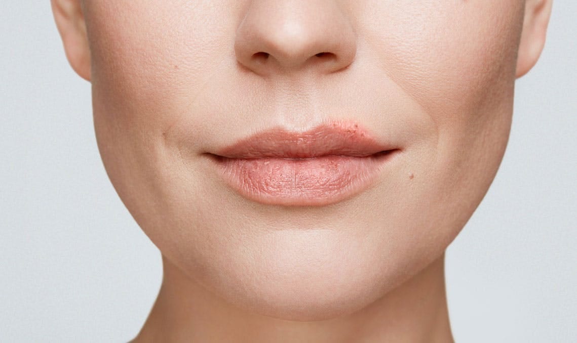 Herpeset Cold Sore Treatment Review — Overview, Uses, Benefits, and