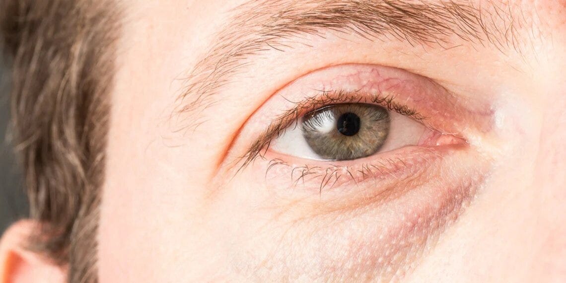 Can Vaping Cause Swollen Eyes?. Vaping has gained popularity in recent