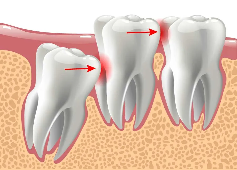 Can You Root Canal a Wisdom Tooth? All You Need to Know