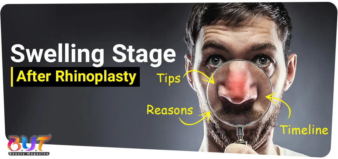 Rhinoplasty swelling stages | tips, reasons, timeline