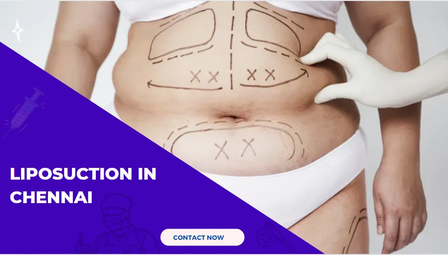 Liposuction :Essential Guide Before Your Procedure