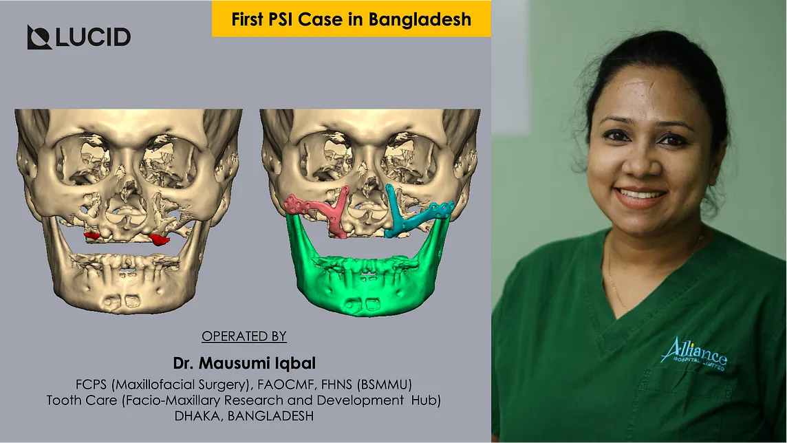 First PSI Case in Bangladesh: Atrophic Maxilla Rehabilitation Using a Custom-Made Subperiosteal…