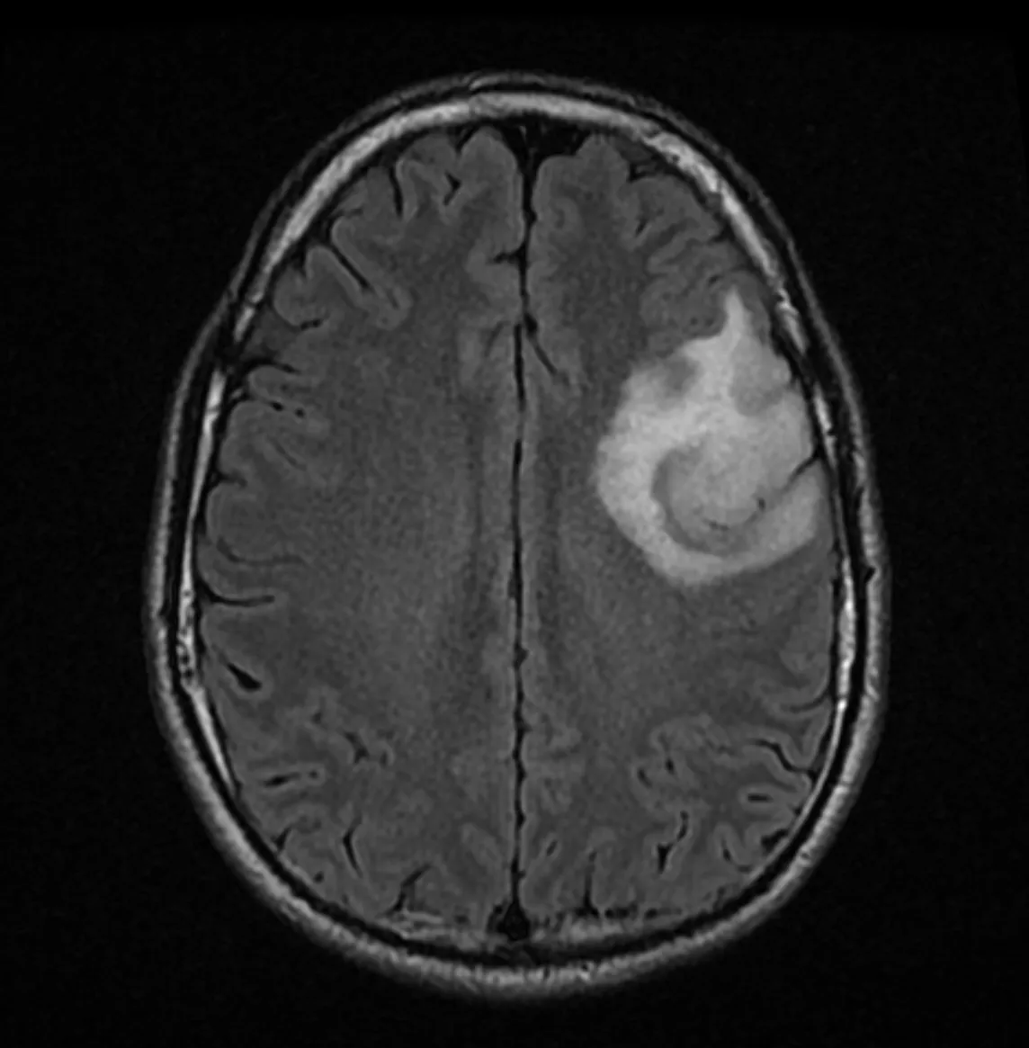 A quick guide to having oligodendroglioma