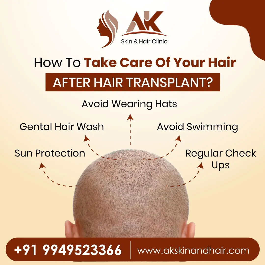 Best hair transplant surgeon in hastinapuram hyderabad