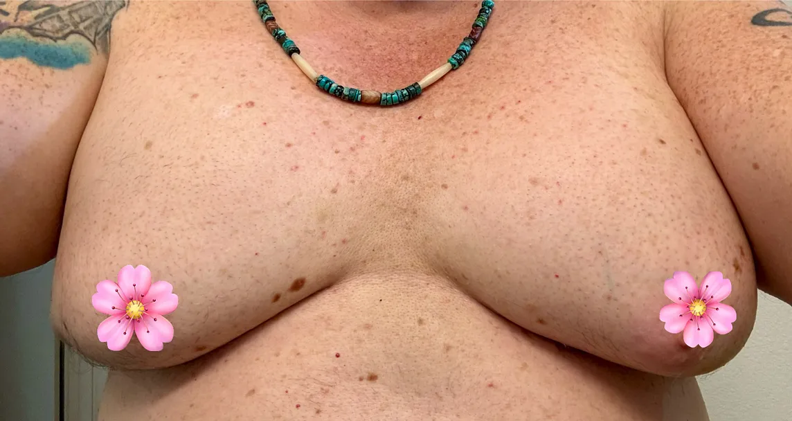 As an Older Trans Woman, I Just Got Big Boobs & They Hurt Like Hell