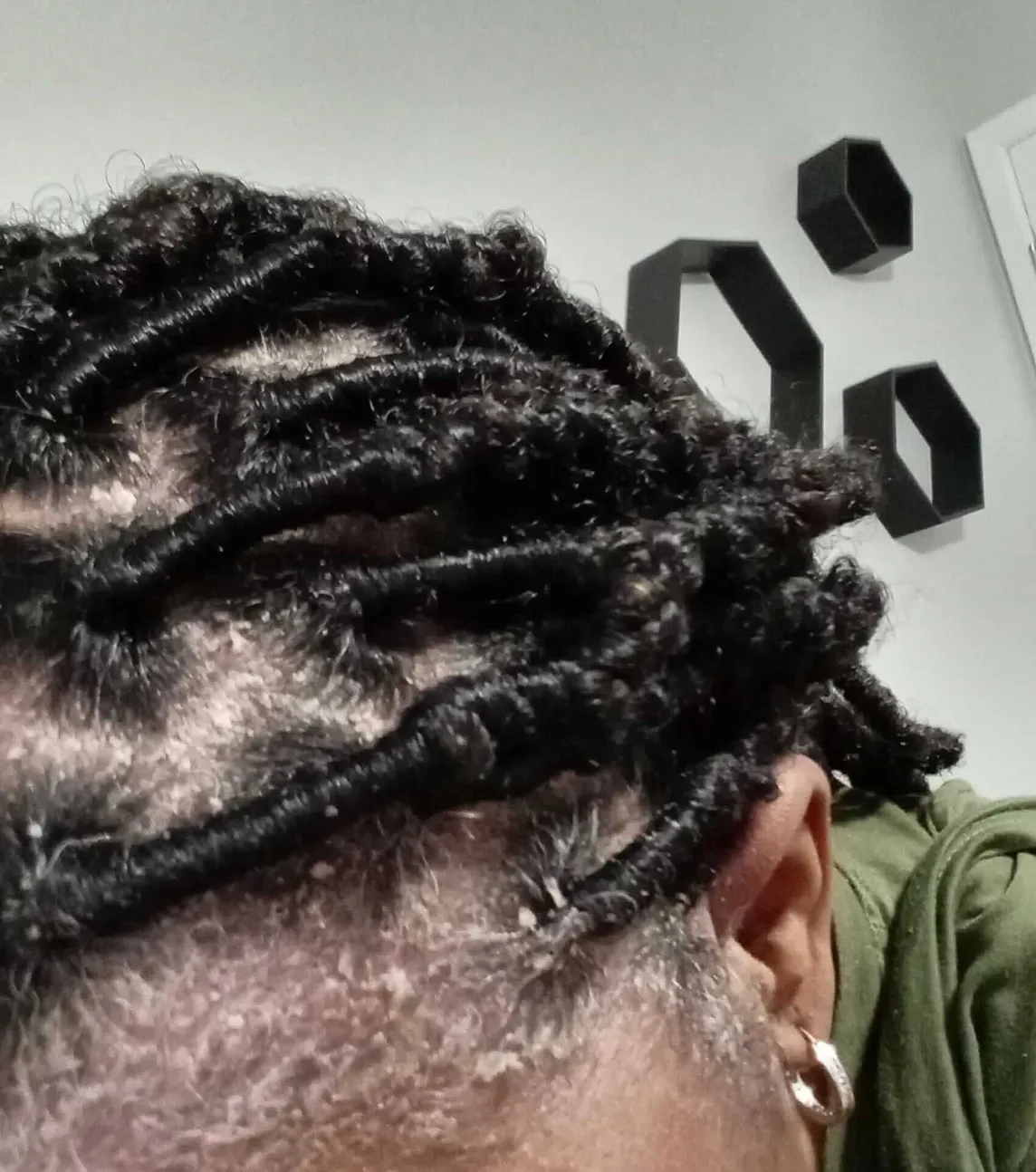 Black woman with hair twist with lots of scaling, flaky dandruff.