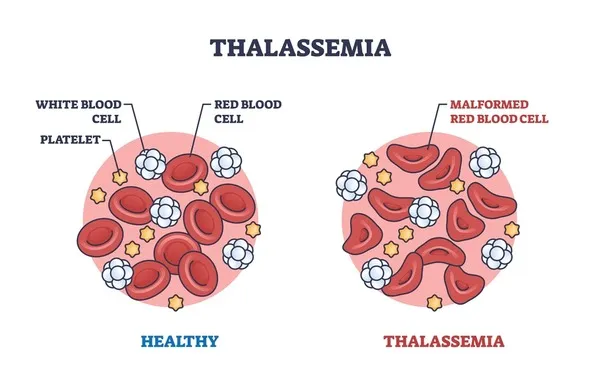 Understanding Thalassemia: