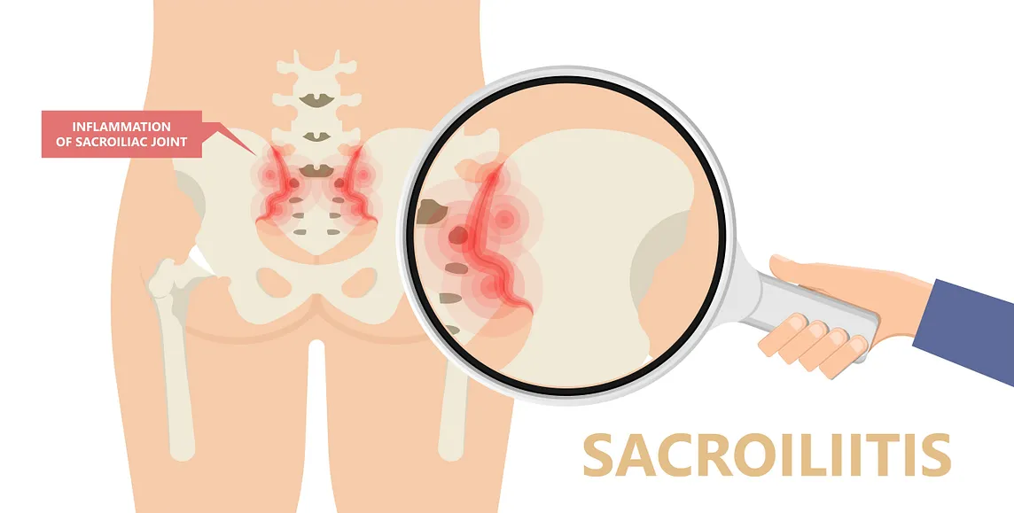 Treatment Choices for Sacroiliac Joint Dysfunction