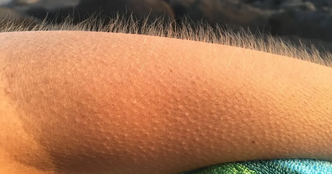 WHY GOOSEBUMPS APPEAR ON THE BODY: THIS ANCIENT REFLEX AND THE SCIENCE BEHIND IT