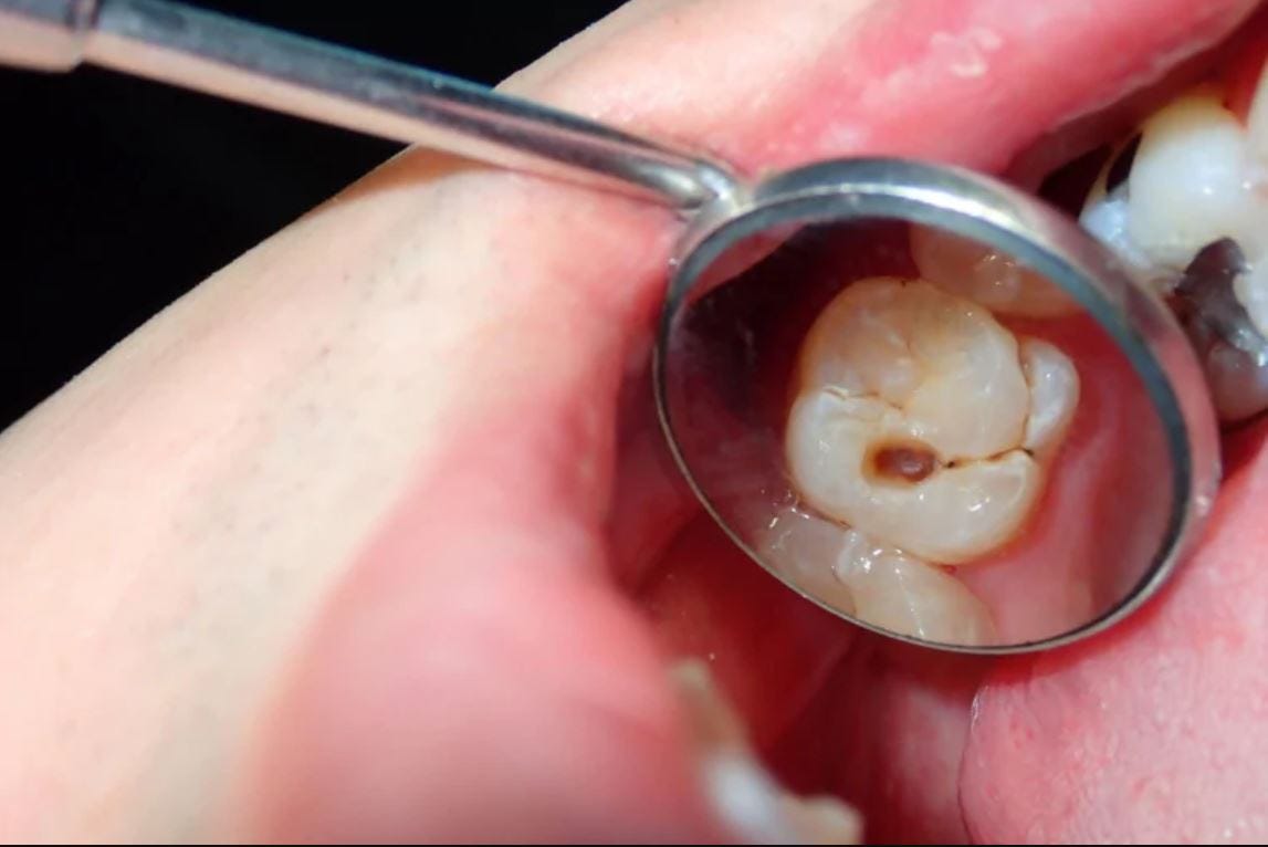 How to stop tooth decay from spreading to other teeth by Oris Dental