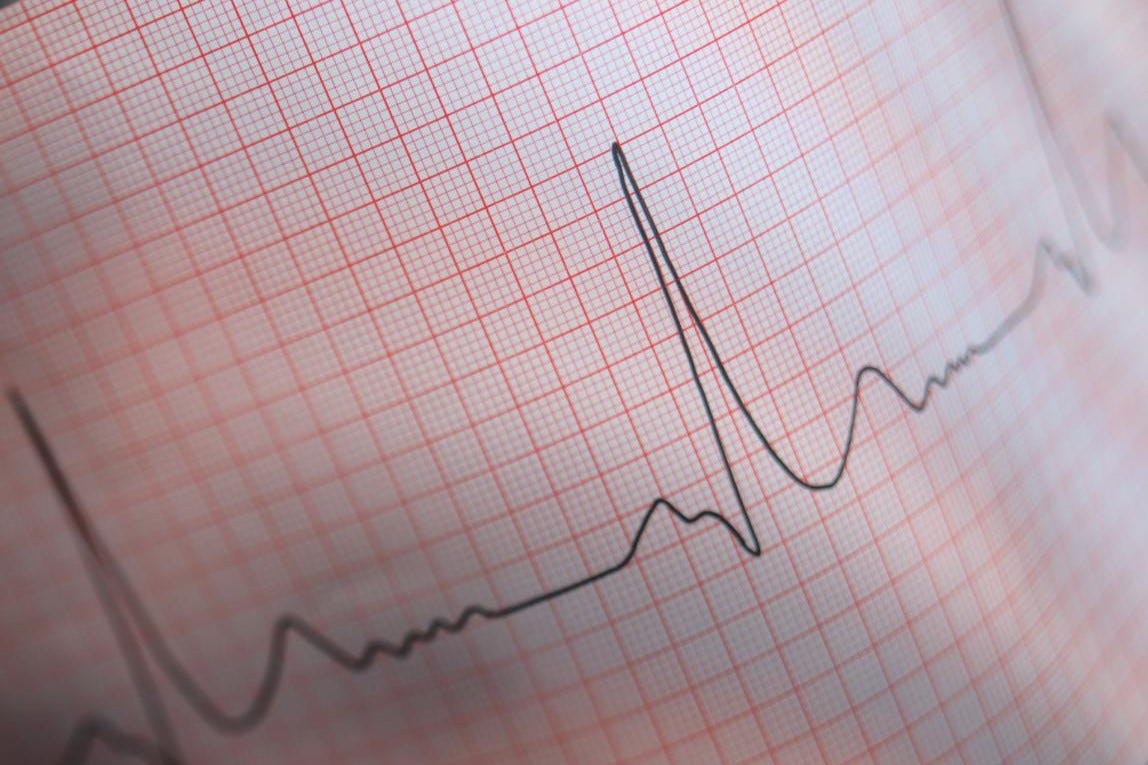 How to analyze an ECG with Python by Alejandro Ena Medium
