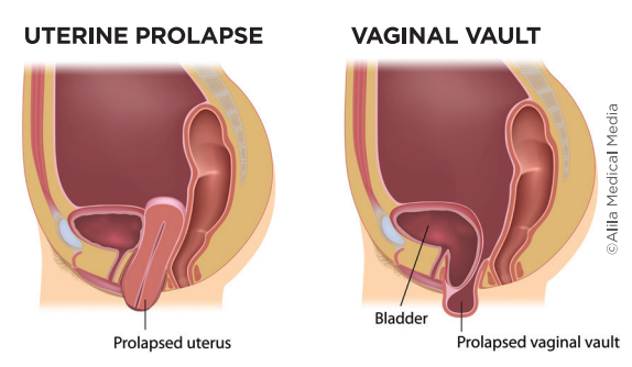 UTERINE - fallen uterus -  - All About Vaginal