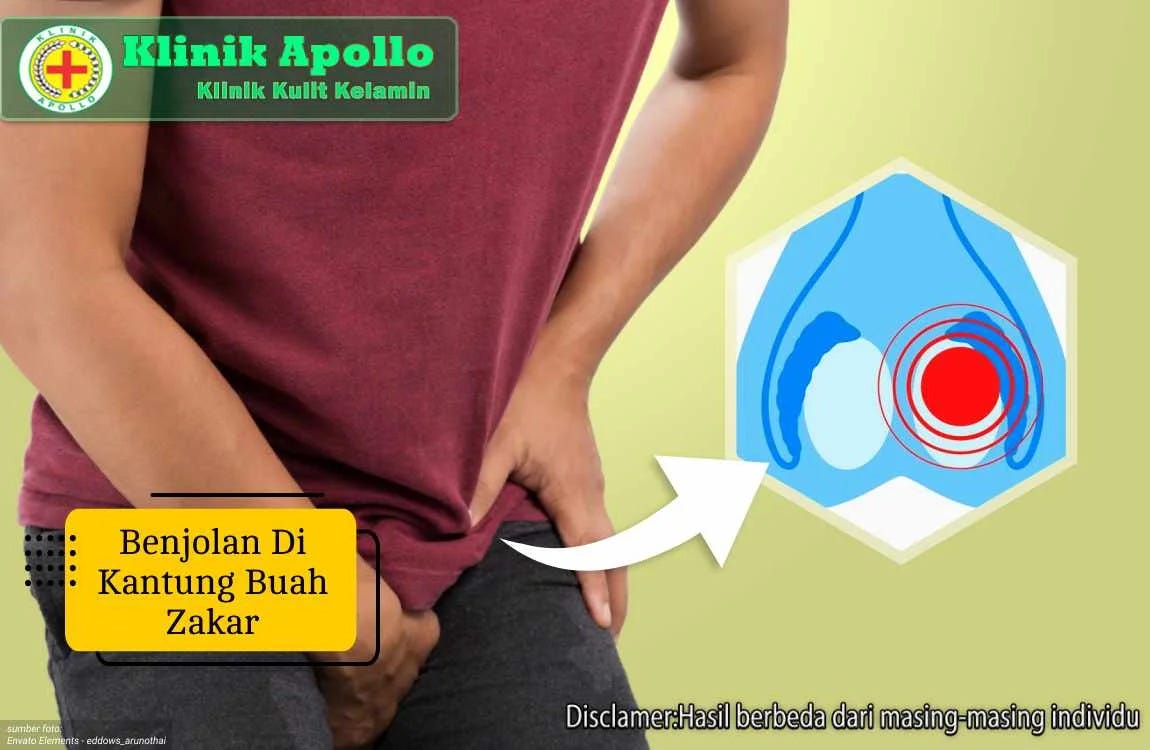 Jangan Abai Benjolan di Kantung Buah Zakar, Ini Fakta Medisnya