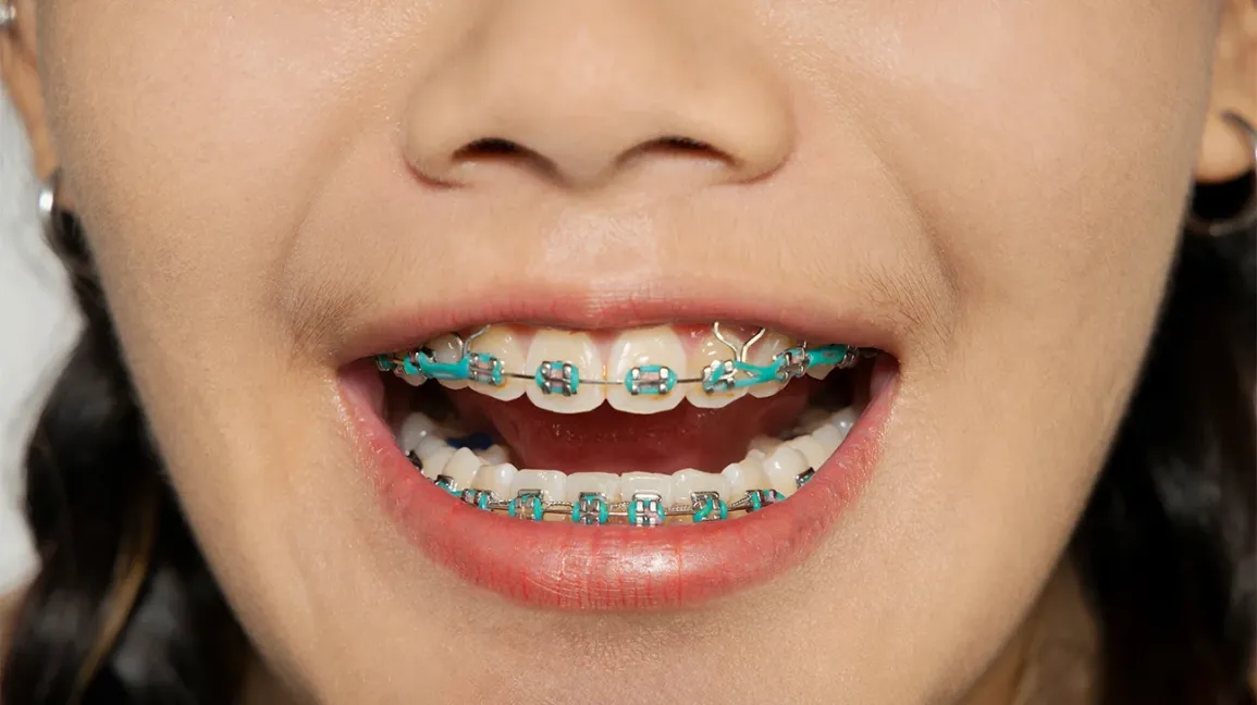 Braces: Straightening Your Smile and Improving Your Oral Health by