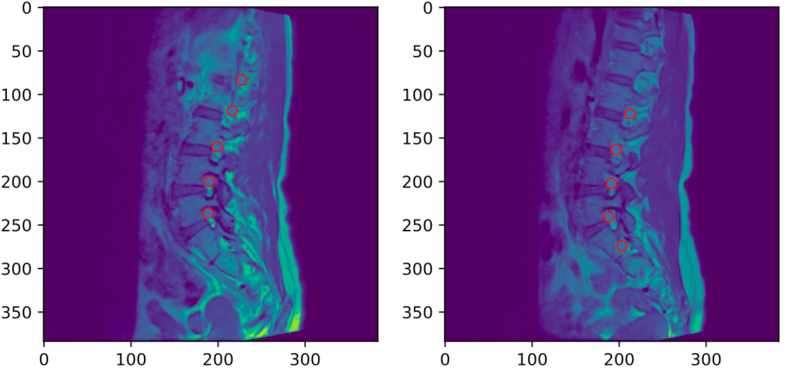 Kaggle RSNA 2024反省（未完成）. 一向に反省しない駄目人間なので締切を作って反省を強制しようとしたけど、駄目人間は… by