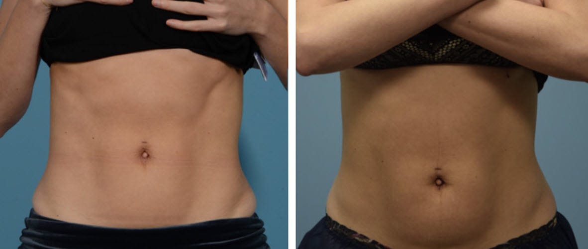 BODY SCULPTING WHAT IS IT AND HOW IS IT DONE? by ALLURE LASER STUDIO Medium