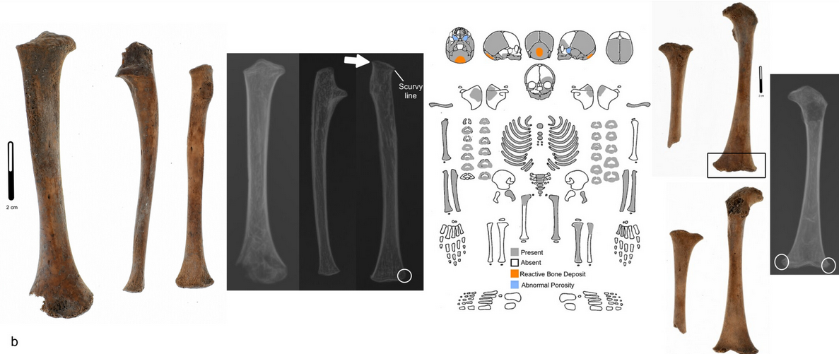 Infant’s bones (ALA-B92) with signs of scurvy, including: White line of Fraenkel (white arrow), Trümmerfeld zones (white line), and Pelkan’s spurs (white circle). A skeletal preservation showing distribution of abnormal bone. Credit: Caine et al. 2026
