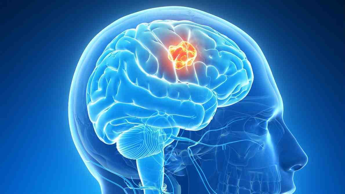 Evasione Shedir Pharma Aneurisma Cerebrale Cause Sintomi E 