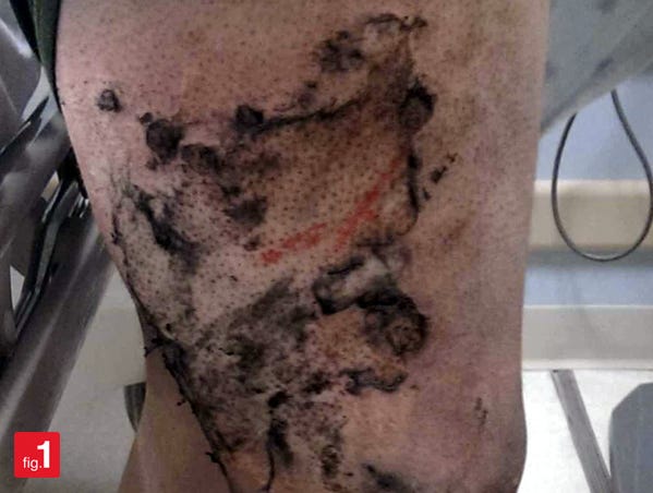 elfbar nachfüll pod läuft aus Philadelphia E-Cigarette Explosion Injury Lawyer main image 1