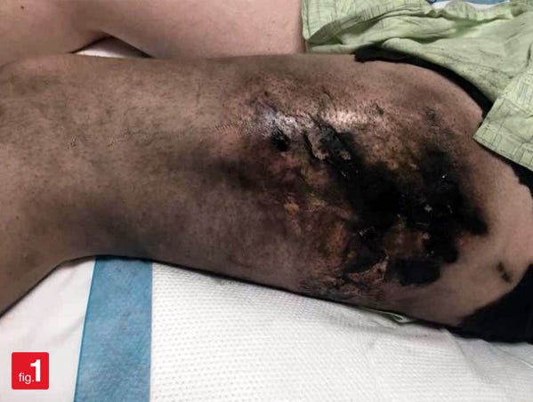 When e-cigarettes explode. Healthcare professionals strongly | by Figure 1  | Figure 1 | Medium