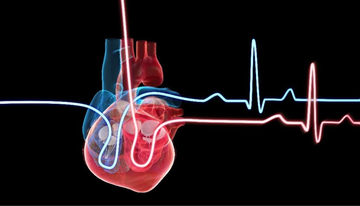 Balloon Mitral Valvotomy (BMV). Percutaneous balloon mitral valvotomy ...