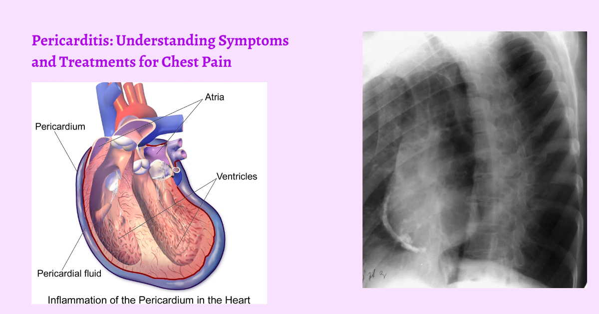 Pericarditis Understanding Symptoms And Treatments For Chest Pain, 8