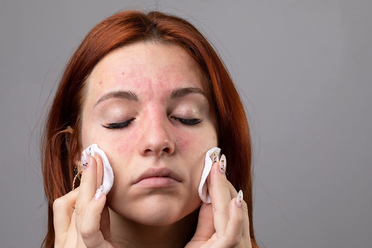 Preview image for Chronic Skin Conditions and Their Impact on Quality of Life