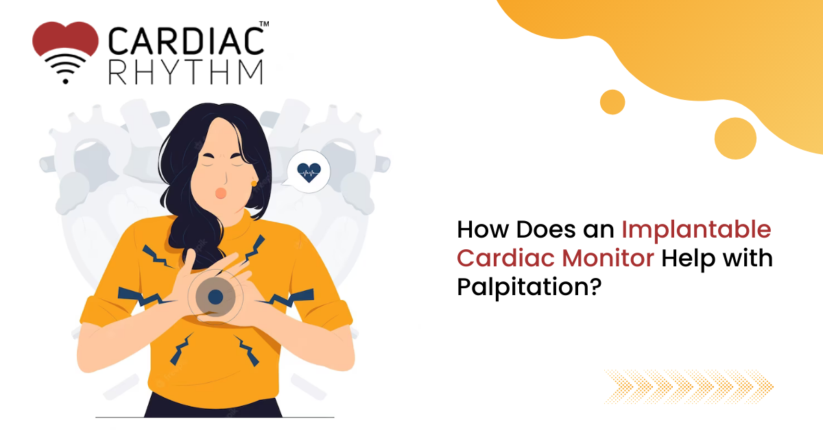 How Does an Implantable Cardiac Monitor Help with Palpitation Cardiac