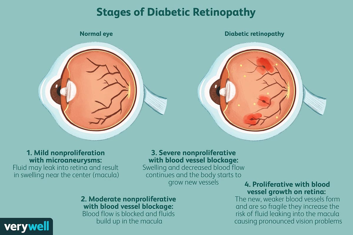 Can Diabetes Blurred Vision Be Corrected by Oct