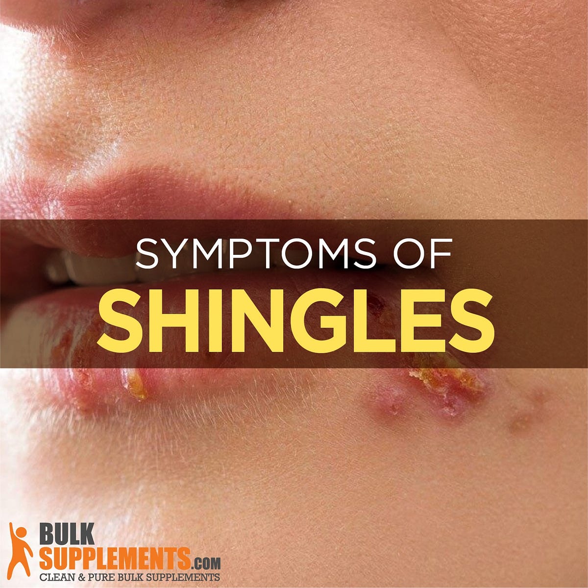 Shingles Causes Symptoms And Treatment By James Denlinger Medium