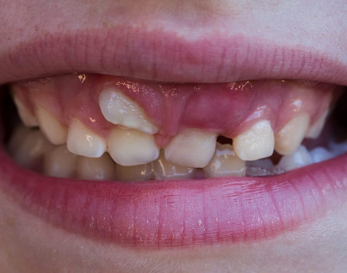 The Impact of Overlapping Teeth Treatment in Dubai | by Dental ...