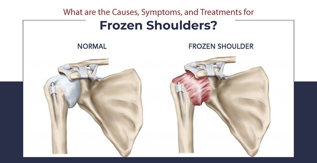 Causes, Symptoms, and Treatments for Frozen Shoulders by Om Physio