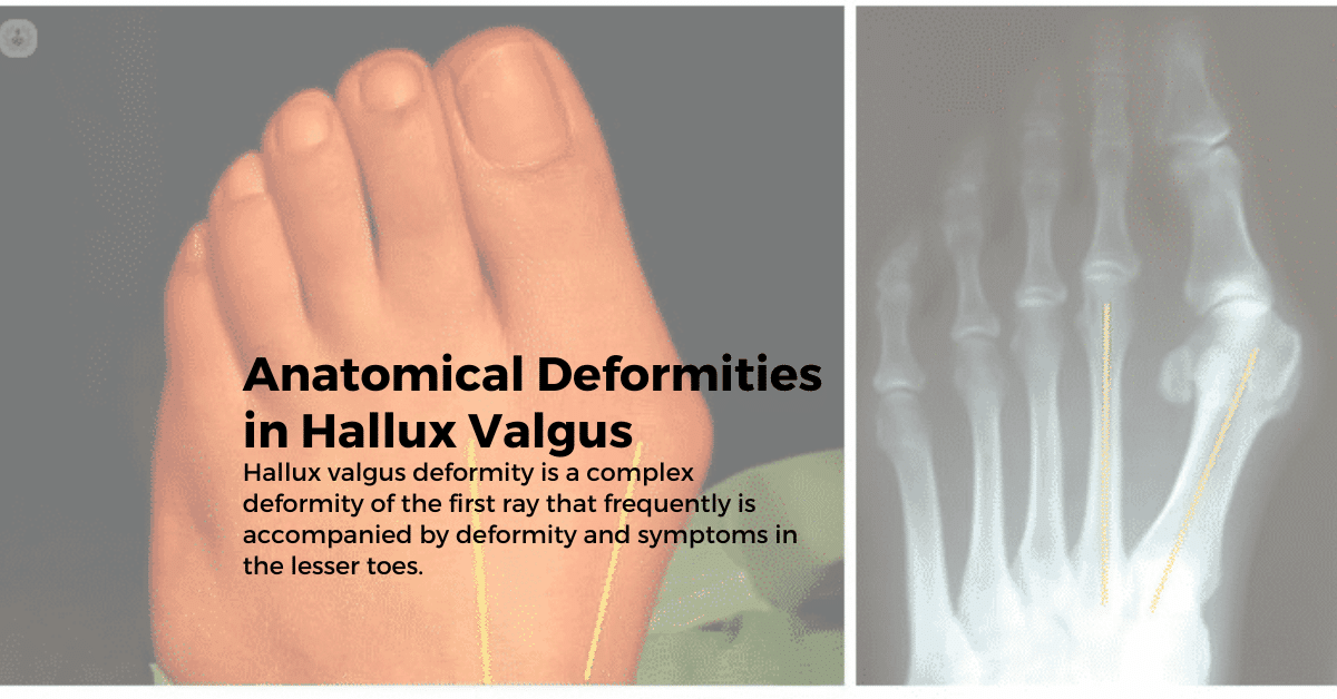 Anatomical Deformities in Hallux Valgus | by Orthofixar Orthopedic | Medium