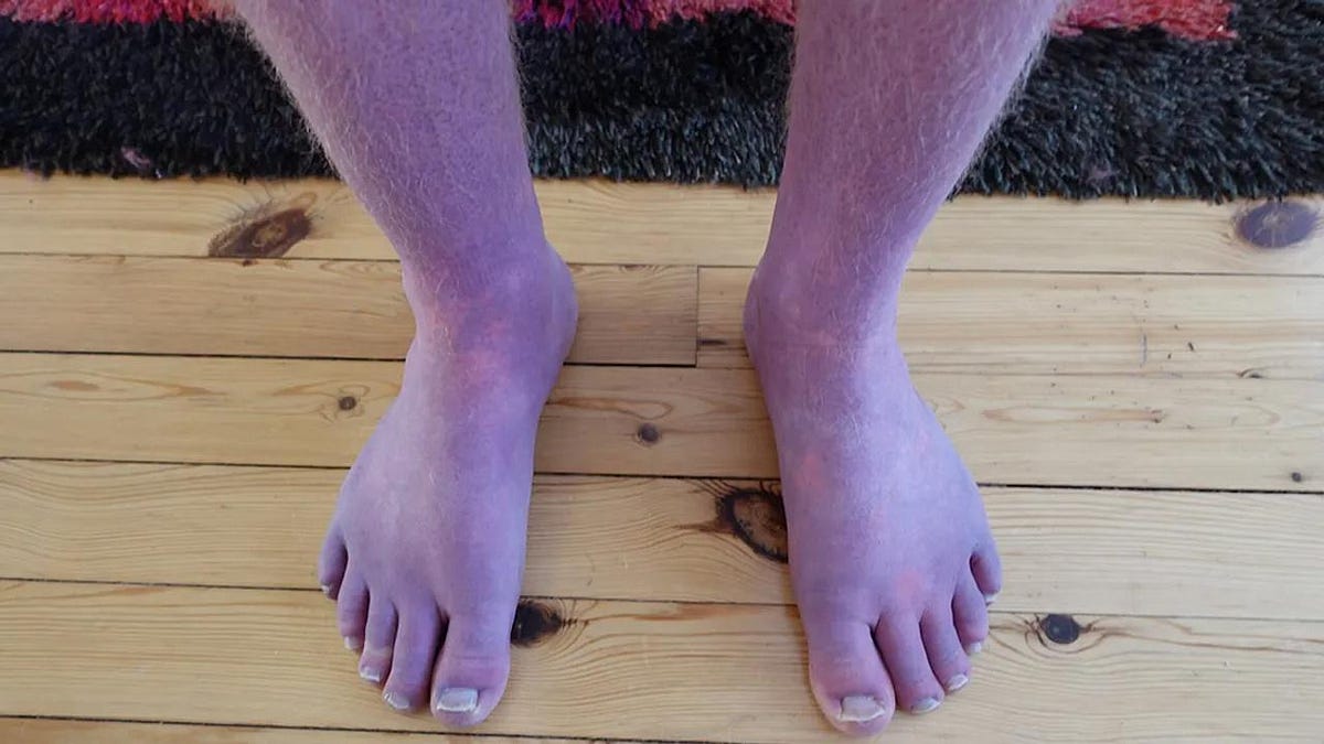 This man’s feet and legs turn purple when he stands; The reason is that