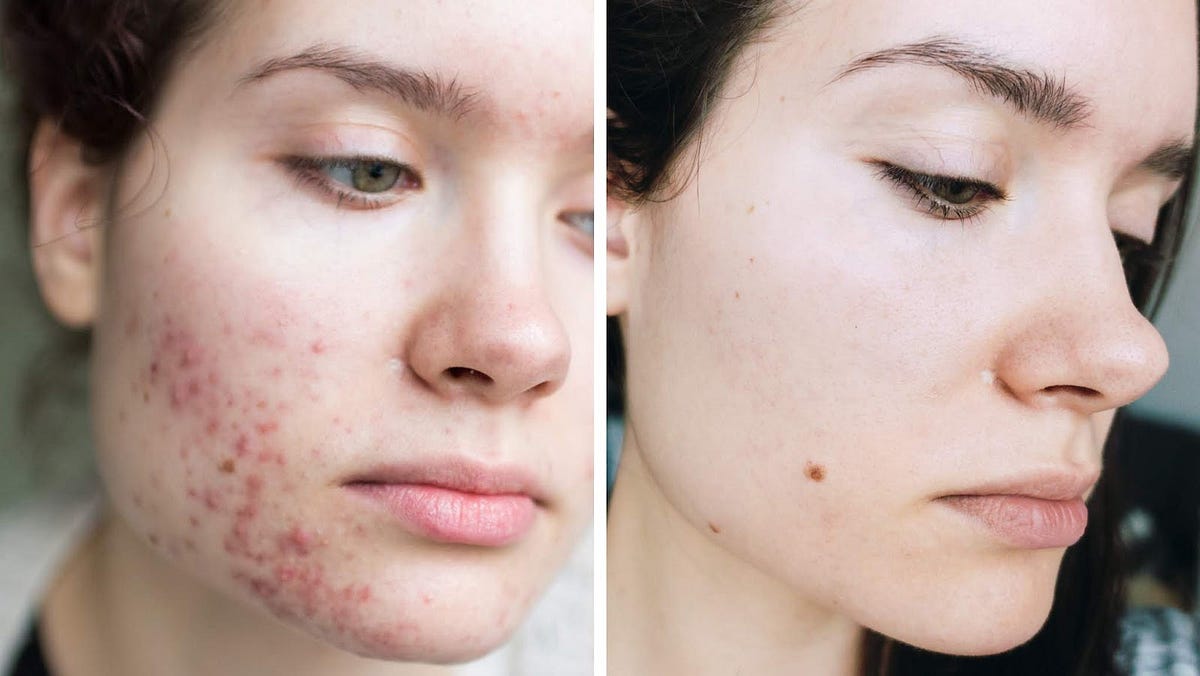 Decoding Acne Scars: A Comprehensive Guide  by Institute Cosmetique 
