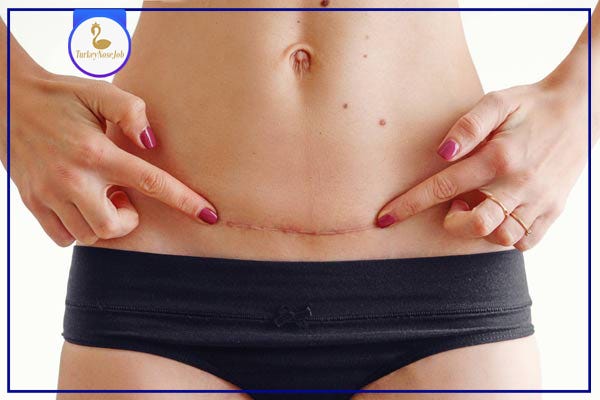 Liposuction or Tummy Tuck for a Flatter Stomach?, by Turkeynosejob Com