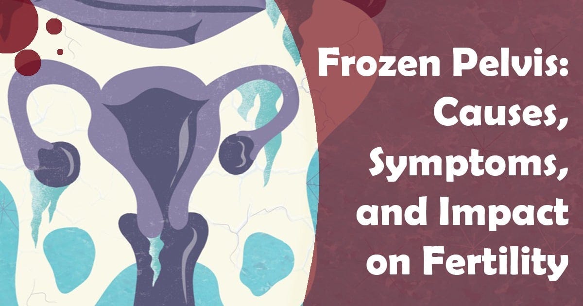 Frozen Pelvis: Causes, Symptoms, and Impact on Fertility
