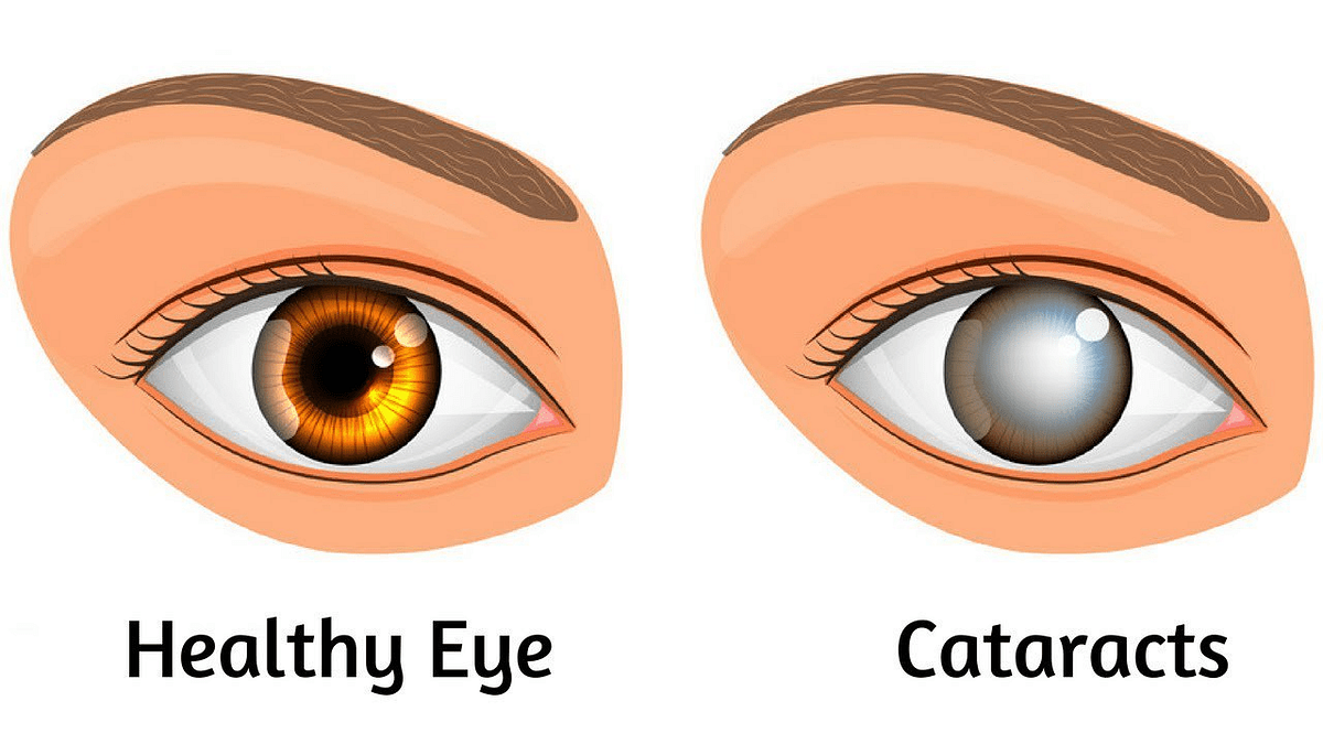 How Cataracts Affect Your Vision. Cataracts are a common eye condition