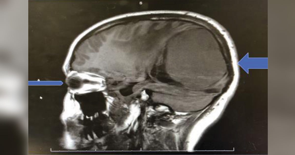 Occasional Flashes In Peripheral Vision by dentalslots Medium