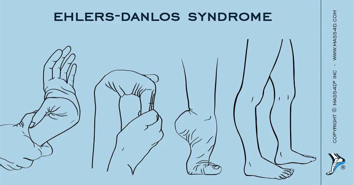 Living with EhlersDanlos Syndrome Type 4 Understanding the Condition