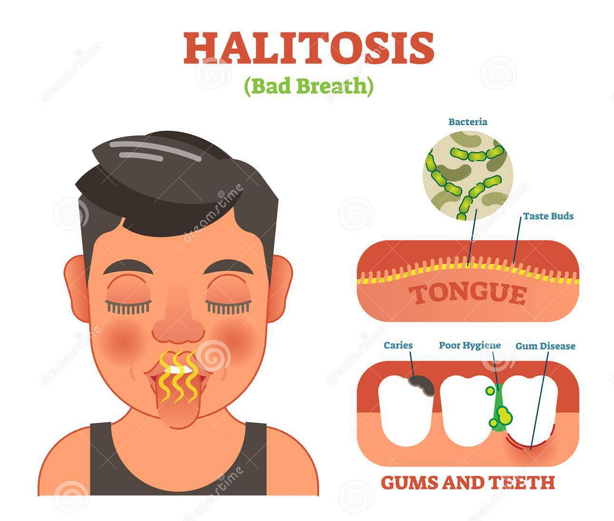 HALITOSIS OR BAD BREATH. Halitosis is an oral health problem… by