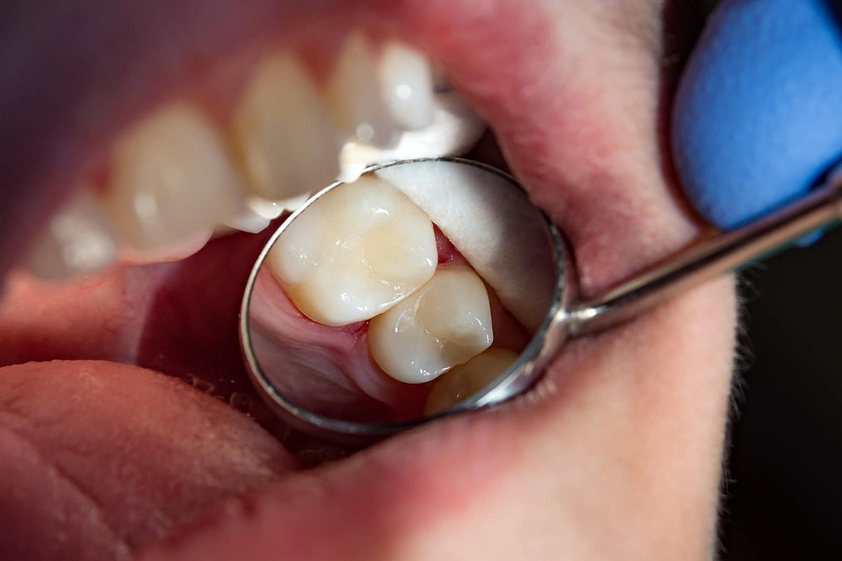 Is a Root Canal Required Before Getting Dental Crowns? by