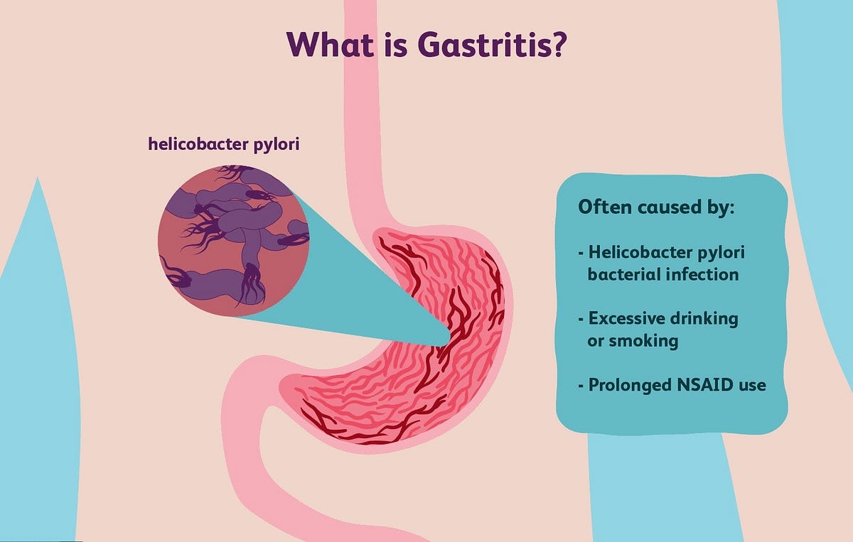 homeopathic medicine for gastritis by Paras Homeopathy Medium